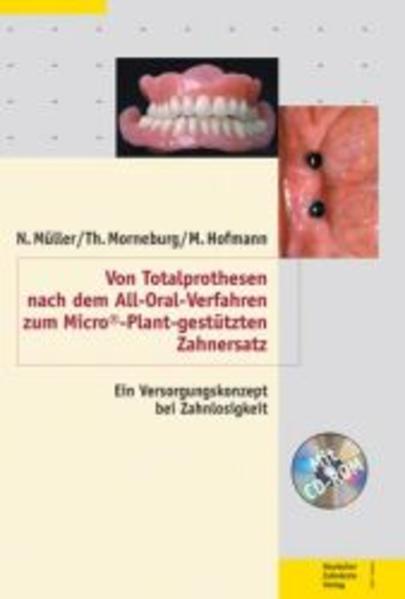 Von Totalprothesen nach dem All-Oral-Verfahren zum Micro©-Plant-gestützten Zahnersatz