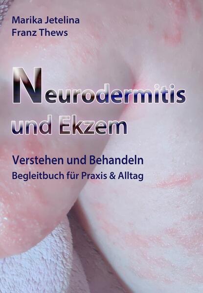 Neurodermitis und Ekzem